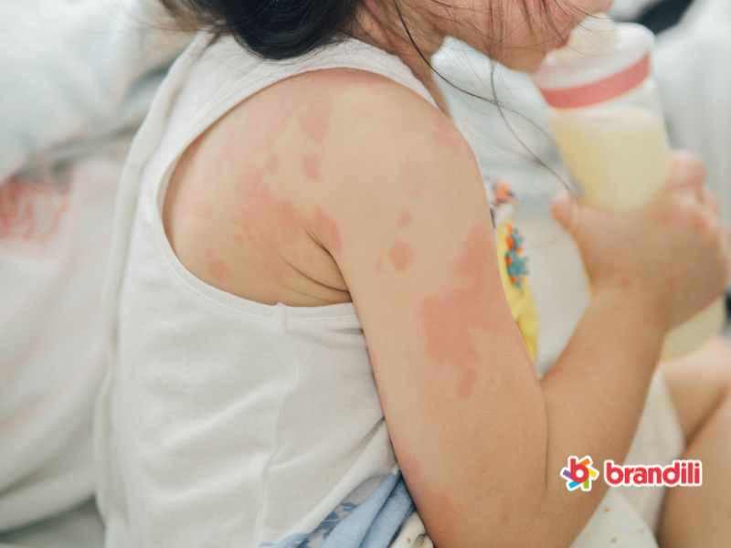 criança com reação alérgica na pele